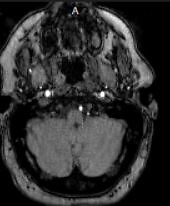 Possible Signs of MS